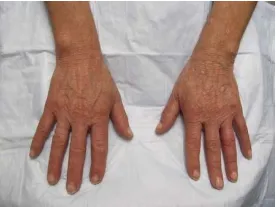 Tay (trái) sau khi điều trị bằng laser q-switch 532 nm của Medlite (Cynosure, Westford, MA) và tay (phải) được điều trị bằng đốt điện