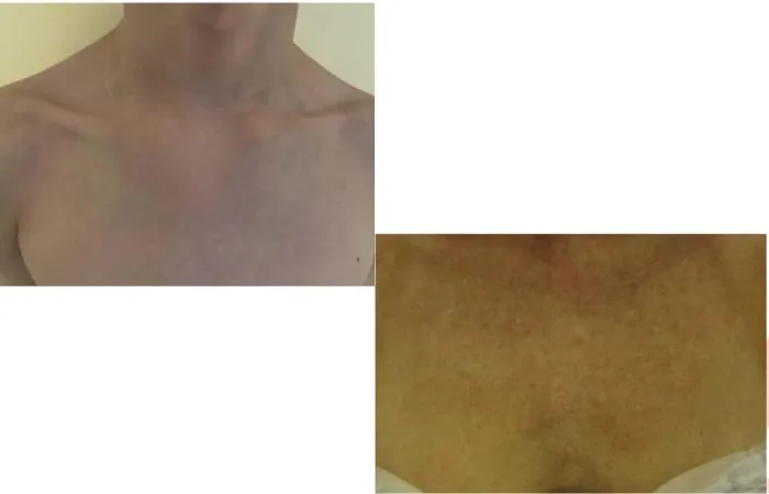 So sánh giữa da vùng ngực “trẻ trung” (trên) với ngực “trưởng thành” (dưới)