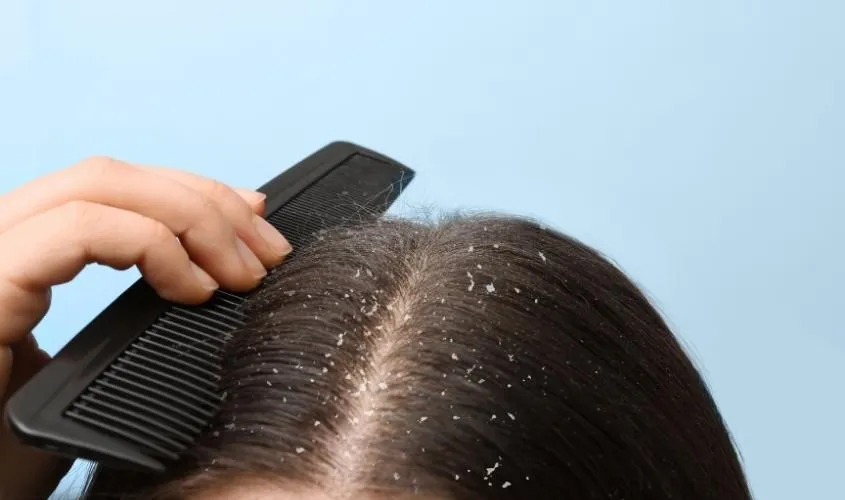 Lựa chọn sản phẩm phù hợp với da đầu và tình trạng gàu
