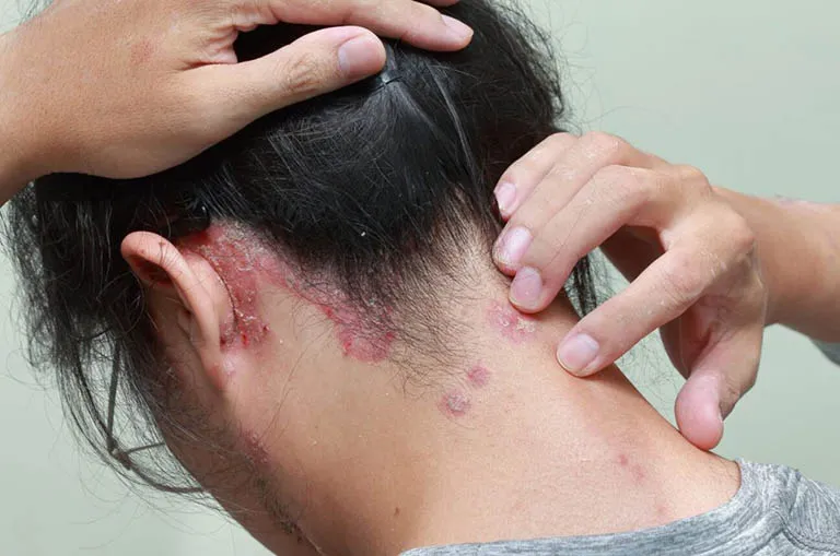 Tình trạng vi khuẩn và nấm trên da đầu