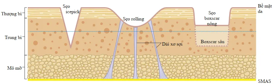 Sẹo Icepick, rolling và boxcar (nông và sâu). Đường màu vàng tượng trưng cho hệ thống cân cơ nông vùng mặt (SMAS), nơi các dải xơ bám vào, tạo ra sẹo rolling..