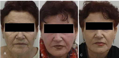 Một bệnh nhân 69 tuổi trước (A), 10 ngày sau (B) và 3 tháng sau (C) thủ thuật.
