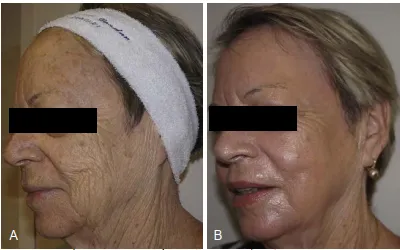 Một bệnh nhân 82 tuổi trước (A) và 4 tuần sau (B) peel