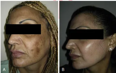 Một bệnh nhân da ngăm đen trước (A) và 6 tháng sau (B) peel
