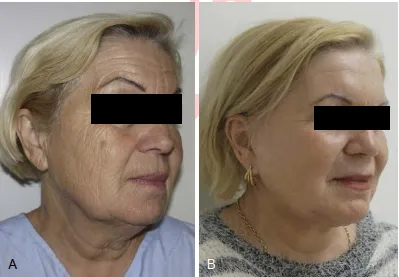Một bệnh nhân 60 tuổi trước (A) và 5 năm sau (B) peel