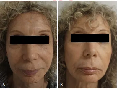Một bệnh nhân 70 tuổi trước (A) và 6 tháng sau khi (B) peel segment
