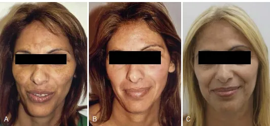 Một bệnh nhân da sẫm màu trước (A), 3 tháng sau (B) và 12 năm sau (C) peel da