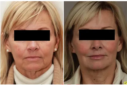 Người phụ nữ 63 tuổi với những biểu hiện lão hóa rõ. Hình trước và 4 tháng sau khi peel