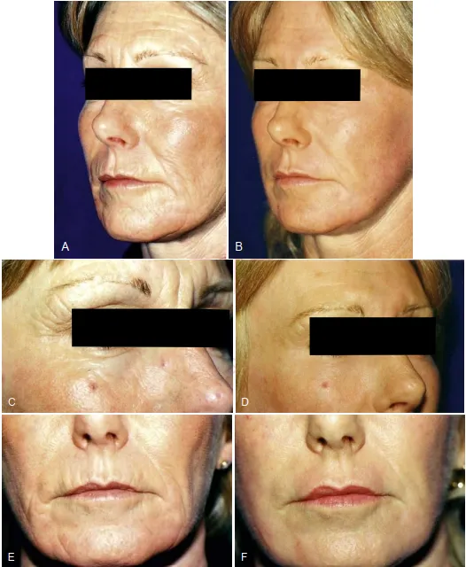 A, Một người phụ nữ 49 tuổi có nếp nhăn sâu, giảm đàn hồi da và các nếp nhăn của người hút thuốc. B, Postpeel 8 tháng. Chủ ý thấy cải thiện chất lượng của da và giảm các nếp nhăn chính. C, Prepeel và, D, postpeel của vùng ổ mắt và gian mày. Da mi trên co lại rõ và cải thiện các nếp nhăn sâu. E, Prepeel và F, postpeel của khu vực quanh miệng