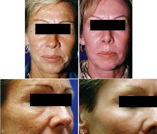 A, Một người phụ nữ 47 tuổi bị tổn thương da do ánh sáng mặt trời nghiêm trọng, giảm độ đàn hồi và dày da. B, Bốn năm postpeel. Cải thiện tổng thể về chất lượng của da và thậm chí cả sắc tố da. C, Prepeel. D, Một năm postpeel.