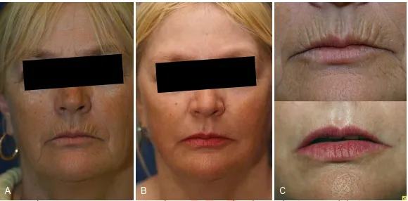 A, Một người phụ nữ 59 tuổi với tình trạng sạm da, xỉn màu do tác hại của ánh nắng mặt trời và các nếp nhăn rõ ở môi trên. B, Postpeel một năm cho thấy sự cải thiện tổng thể và, C, hiệu quả xóa bỏ hoàn toàn các đường nhăn quanh miệng