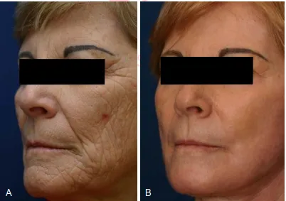 A, Một phụ nữ 65 tuổi có với biểu hiện lão hóa kết cấu da là chính. Tái tạo bề mặt được ưu tiên hơn so với chỉnh sửa phẫu thuật. B, Postpeel một năm với vẻ ngoài được cải thiện đáng kể và rối loạn sắc tố đã được điều trị