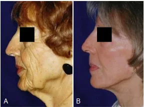 A, Một phụ nữ 75 tuổi bị lão hóa đáng kể về cấu trúc và kết cầu da. B, Kết quả ở tuổi 81, 5 năm sau khi căng da mặt và 1 năm sau peel, thể hiện giá trị của việc kết hợp các phương pháp trẻ hóa