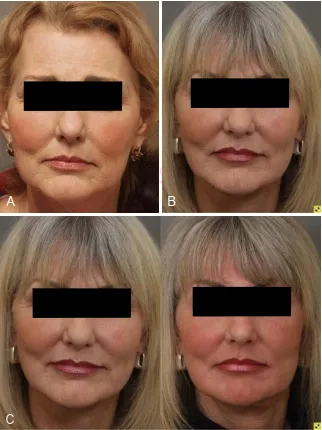 A, Một phụ nữ 63 tuổi có cả ba biểu hiện của lão hóa da mặt: chảy xệ điển hình, jowling và nếp nhăn. B, Một năm sau căng da mặt và ghép mỡ mặt với sự cải thiện đáng kể về cấu trúc và thể tích. C, Một năm rưỡi postpeel. Sự cải thiện của kết cấu và nếp nhăn là yếu tố kết nối mọi thứ với nhau để tạo nên kết quả toàn diện