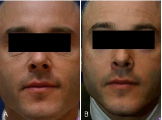 A, Một người đàn ông 44 tuổi có lão hóa da, chủ yếu là sự xuất hiện nếp nhăn và chảy xệ da mi dưới. B, Sáu tháng sau peel da mi dưới. Phần da này đã cải thiện đáng kể mà không thay đổi hình dáng góc mắt ngoài