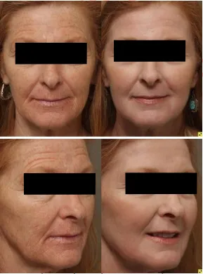 Trái, một phụ nữ 61 tuổi, hút thuốc, với nếp nhăn toàn mặt, tổn thương da do ánh sáng lan rộng, thay đổi sắc tố và xuất hiện lão hóa rõ ràng. Bên phải, 6 tháng sau peel mà không cần phẫu thuật. Trường hợp này chứng tỏ ‘sức mạnh’ của phenol- dầu croton trong việc trẻ hóa. Vẻ ngoài của một người sẽ trông trẻ hơn, đầy sức sống