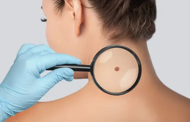 Kỹ thuật Mohs thường được sử dụng đối với ung thư da tái phát và trên khuôn mặt