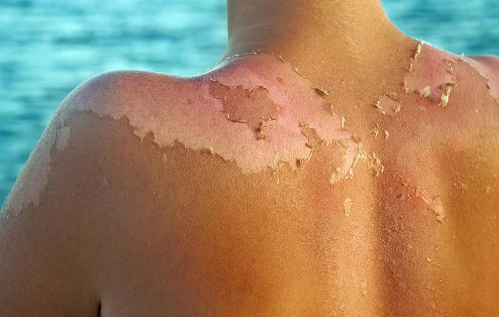 Phòng ngừa tổn thương da do tác động của ánh nắng mặt trời là một phần quan trọng