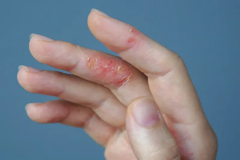 Phát ban dạng chàm - Viêm da cơ địa dị ứng cũng thường gặp phức tạp do nhiễm trùng da