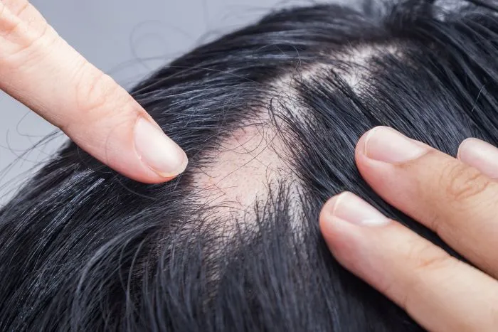 "Alopecia" là thuật ngữ chỉ sự rụng tóc