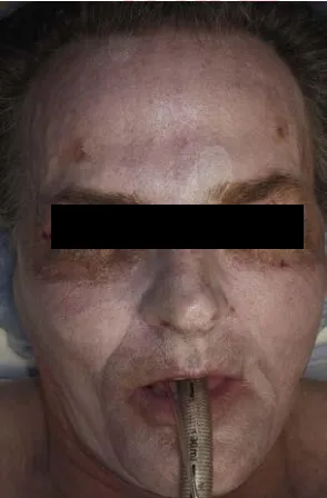 Bệnh nhân này đã được thực hiện phẫu thuật tạo hình mi dưới và peel toàn mặt. Bởi vì mi dưới bị chảy xẹ đáng kể, BS đã chỉ định điều trị bằng laser CO2 trên khu vực này