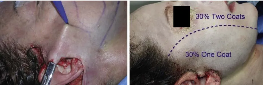 Hình ảnh bên trái các vạt da bóc tách được đánh dấu để phân định giữa vùng được và không được phẫu thuật. Hình bên phải cho thấy vùng trung tâm hình oval (không can thiệp phẫu thuật) được peel bằng 2 lớp TCA 30%, còn vùng can thiệp thì chỉ được peel bằng 1 lớp