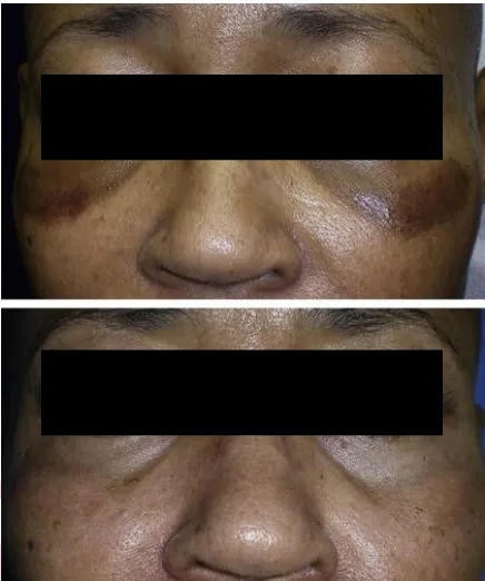 Phía trên là hình ảnh BN sau peel quanh mắt và laser (mi trên) 3 tháng, xuất hiện PIH toàn bộ vùng quanh mắt. BN được điều trị 30 ngày bằng HQ và kem chống nắng và hình dưới là kết quả