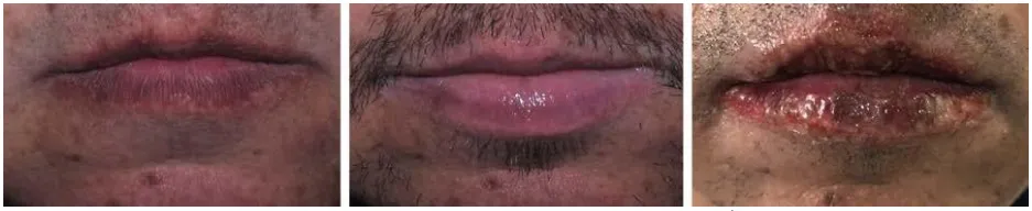 Trước, sau 7 ngày và 3 ngày sau peel môi với mục đích cải thiện đường viền môi ở một bệnh nhân nam với công thức Hetter heavy: 1 mL phenol 88% + 3 mL dd Hetter + 0,5 mL Novisol Cleanser + 5,5 mL nước cất