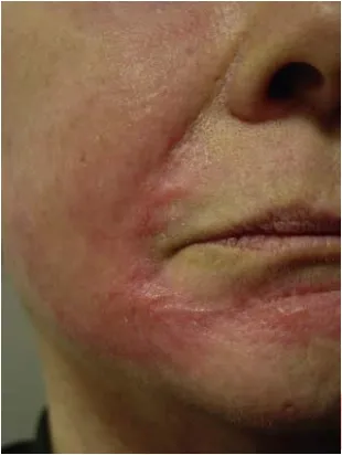 Sẹo phì đại sau khi liệu trình peel TCA (mặt) và mài mòn da (quanh miệng). Mặc dù không có thông tin chi tiết về quá trình thực hiện thủ thuật này, nhưng khả năng sẹo hình thành là do mài mòn da quá sâu hoặc hoạt chất peel xâm nhập được vào vùng da đã mài mòn
