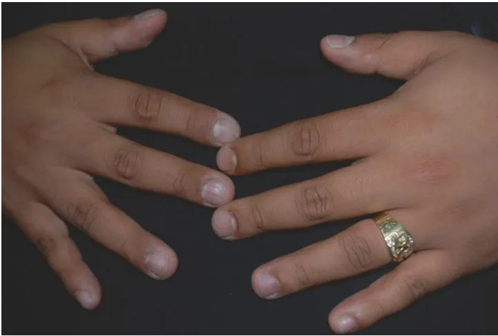 Quan sát sắc tố ở các khớp ngón tay của một bệnh nhân nam 24 tuổi
