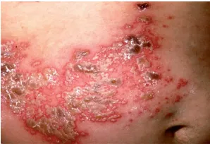 Herpes zoster – sự tái hoạt của virus varicellazoster trong các hạch thần kinh cảm giác gây ra phát ban mụn nước, đau theo phân vùng da