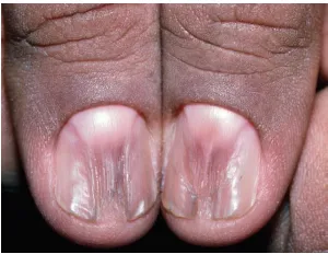 Lichen phẳng – một tình trạng viêm thường ảnh hưởng đến da và niêm mạc, nhưng có thể ảnh hưởng đến chất nền của móng và gây ra loạn dưỡng móng