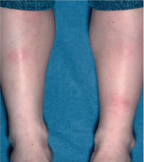 Hồng ban nút. Các nốt dưới da thường thấy nhất ở cẳng chân của phụ nữ sau khi bắt đầu dùng thuốc tránh thai; là kết quả của tình trạng viêm tập trung ở vách ngăn dạng sợi ngăn cách các tế bào mỡ hoặc tiểu thùy mỡ