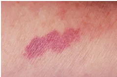 Ban xuất huyết có màu tím và không thể tẩy trắng ở bệnh nhân với làn da mỏng manh do bị tổn thương