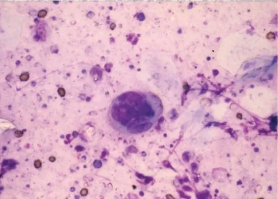 Phết tế bào Tzanck dương tính cho thấy tế bào đa nhân khổng lồ điển hình của nhiễm herpes virus