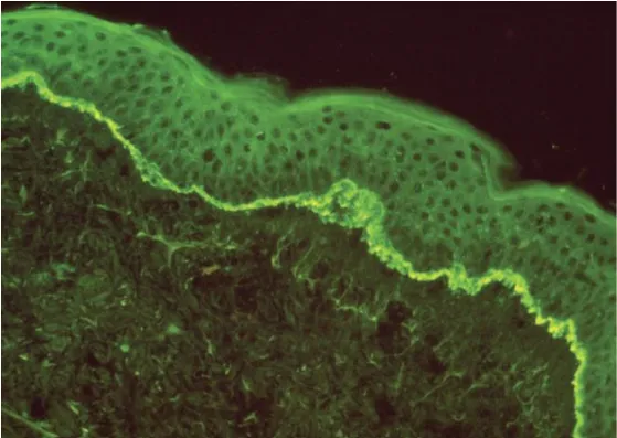 Miễn dịch huỳnh quang dương tính cho thấy sự lắng đọng tuyến tính của immunoglobulin G tại vùng nối biểu bì- bì, đặc trưng của pemphigoid bóng nước