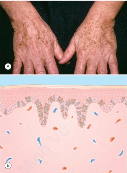 Actinic lentigo. A. Các dát nhỏ màu nâu ở vùng da tiếp xúc với ánh nắng mặt trời của người trung niên. B. Biểu bì – tăng sắc tố lớp đáy do tăng tế bào hắc tố và hắc tố; các gờ rete kéo dài