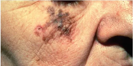 Lentigo maligna melanoma – dát lớn, nâu, đen, hình dạng không đều thường xuất hiện trên mặt người cao tuổi