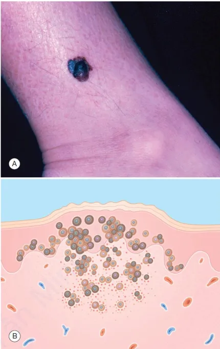 A. U hắc tố dạng nốt – nốt xanh đen. B. Biểu bì – tế bào sắc tố melanoma không điển hình. Lớp bì – các tổ có kích thước khác nhau của các tế bào sắc tố melanoma không điển hình, viêm