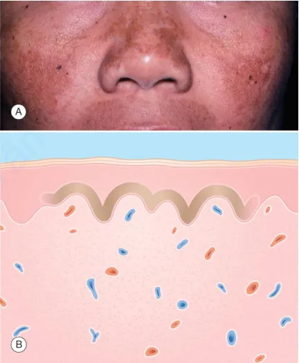 Nám da. A. Các dát màu nâu trên mặt – mũi, má và môi. B. Biểu bì – sắc tố melanin ở lớp đáy