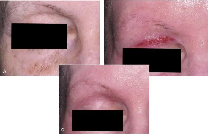 Hình ảnh sau peel quanh mắt ở một bệnh nhân peel toàn mặt bằng 1,6% dầu croton trong 35% phenol. A, Trước peel. Cố tình peel tập trung vào vùng mi trên để tạo ra hiện tượng co kéo (mô cũng lâu lành hơn). B, Sau thủ thuật ngày thứ 10 (POD). C, Không thấy sẹo tại ngày thứ 30 sau thủ thuật