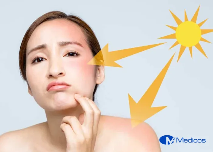 Tia UV là nguyên nhân gây ra nám và là tác nhân ngăn cản quá trình điều trị nám