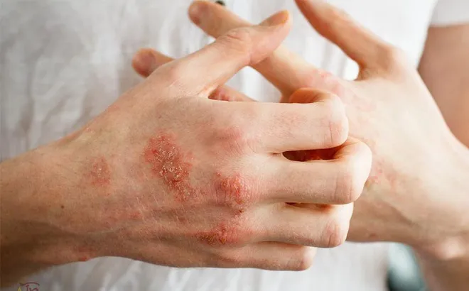 Cạo ghẻ (Scabies Scraping)