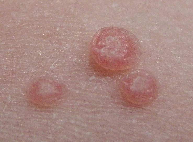 Tăng sinh tế bào biểu mô - U mềm lây là một trong những biểu hiện da phổ biến nhất trong hội chứng suy giảm miễn dịch tự nhiên