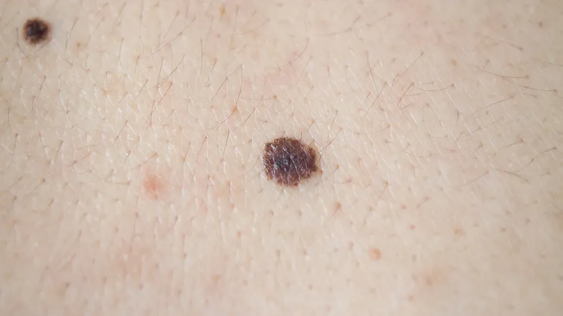 Tăng sinh sắc tố da - Các phương pháp điều trị miễn dịch cho melanoma