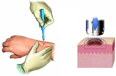 Điều trị và quy trình da liễu - Sinh thiết da (Skin Biopsy)