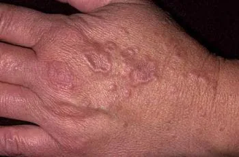 Cấu hình của các tổn thương bệnh về da