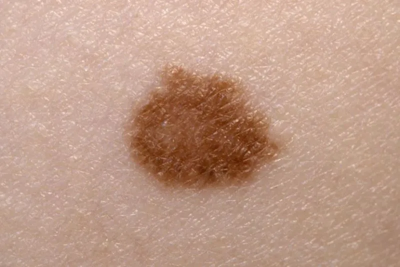 Tăng sinh sắc tố da - Hội chứng melanoma và nốt ruồi không điển hình