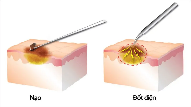 Điều trị và quy trình da liễu - Nạo và đốt điện (Curettage Electrodesiccation)