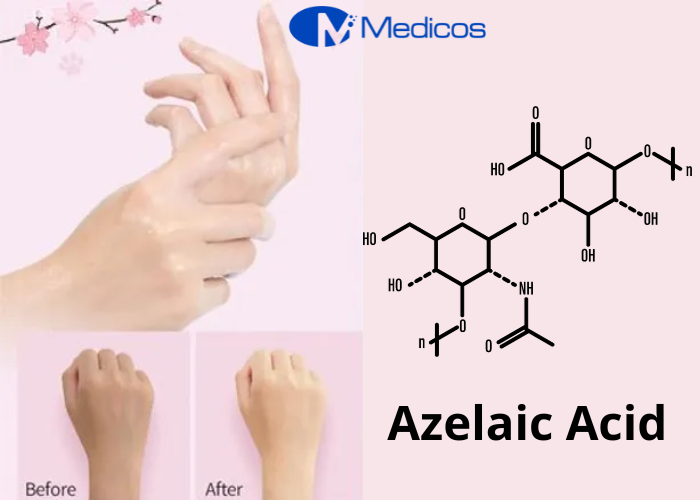 Azelaic Acid trong mặt nạ tay